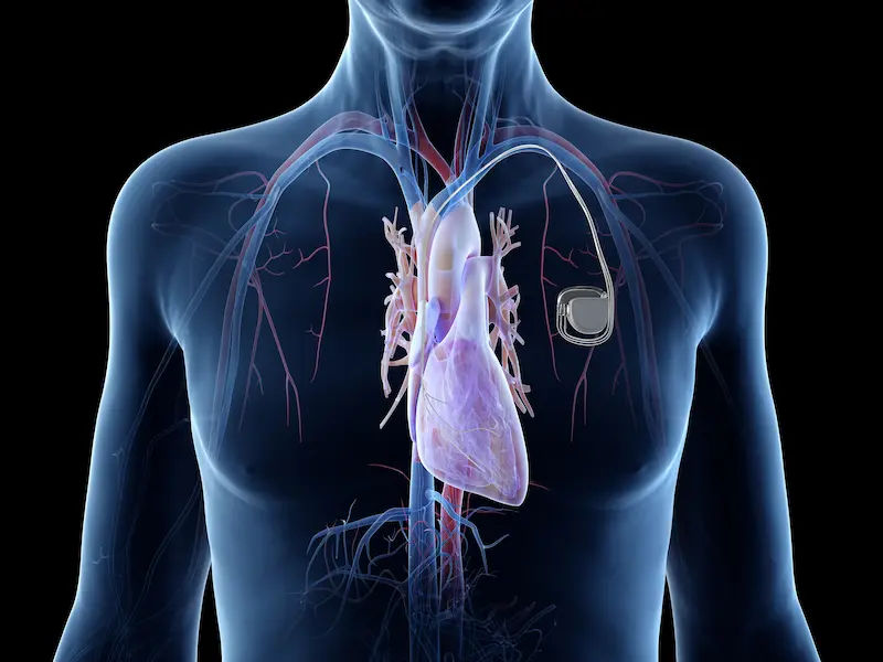 New Generation Pacemakers Smarter, Safer Heart Care